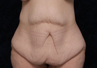 35 Year Old Female, Beltlift After Gastric Bypass before 1409503