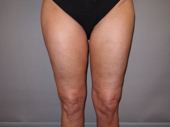49 Year Old Female treated for Cellulite Reduction - Cellulaze after 1052959