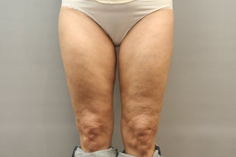 49 Year Old Female treated for Cellulite Reduction - Cellulaze before 1052959