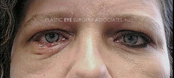 45-54 year old woman treated with Eyelid Retraction Repair before 3319545