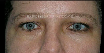 45-54 year old woman treated with Eyelid Retraction Repair after 3319545