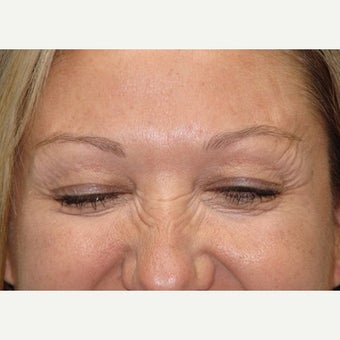 45-54 year old woman treated with Botox after 2502788