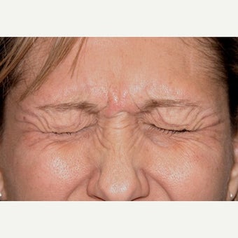 45-54 year old woman treated with Botox before 2502788