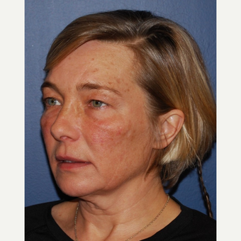 45-54 year old woman treated with Facelift before 3428257