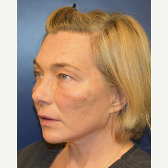 45-54 year old woman treated with Facelift after 3428257