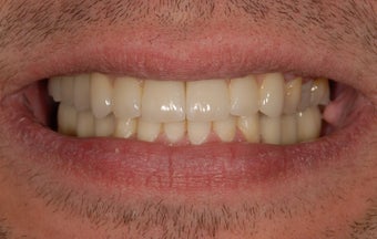 Repalcement of hopeless teeth with implant supported bridges after 1041589