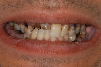 Repalcement of hopeless teeth with implant supported bridges before 1041589