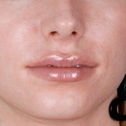 25-34 year old woman treated with Rosacea Treatment after 2346014
