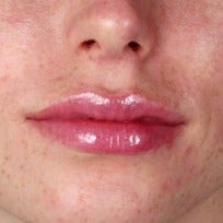 25-34 year old woman treated with Rosacea Treatment before 2346014