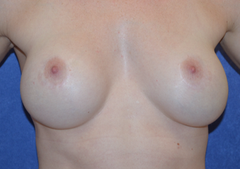 25-34 year old woman treated with Breast Implant Revision before 3692166