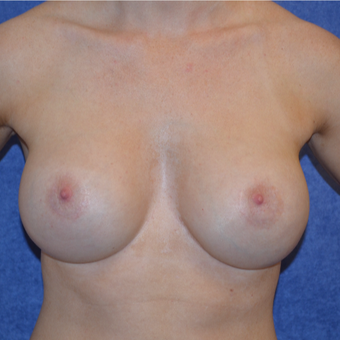 25-34 year old woman treated with Breast Implant Revision after 3692166