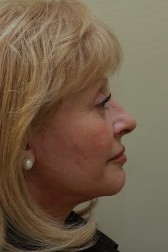 Facelift (Profile View) after 102557
