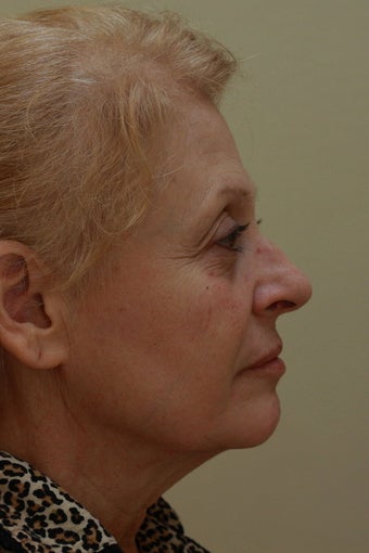 Facelift (Profile View) before 102557