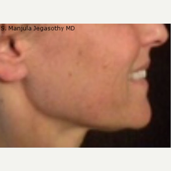 Viora® Radiofrequency Laser For "Accordian Cheeks" after 2833342