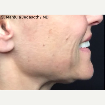 Viora® Radiofrequency Laser For "Accordian Cheeks" before 2833342