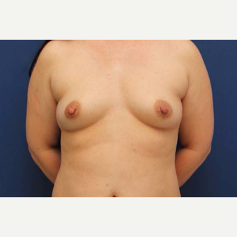 41 year old female, 350cc moderate-plus profile, silicone gel breast implants, submuscular before 3814681