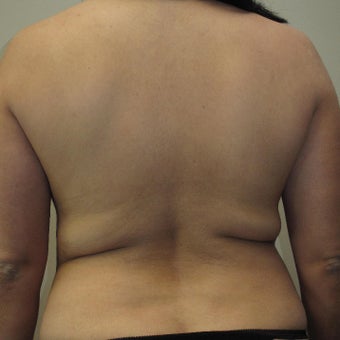 35-44 year old woman treated with Mommy Makeover 1575649