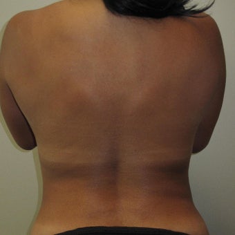 35-44 year old woman treated with Mommy Makeover 1575649