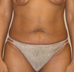 45-54 year old woman treated with Tummy Tuck before 2217001