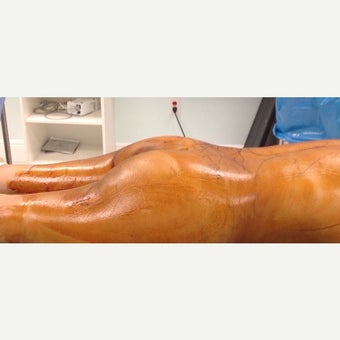 45-54 year old woman treated with Brazilian Butt Lift before 1783721