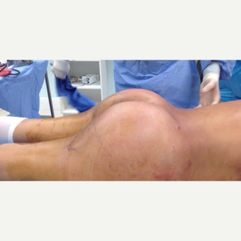 45-54 year old woman treated with Brazilian Butt Lift after 1783721