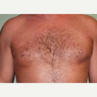 35-44 year old man treated with Male Breast Reduction after 2977717