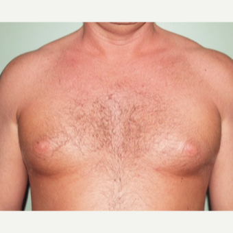 35-44 year old man treated with Male Breast Reduction before 2977717