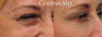 Botox treatment to minimize the appearance of crows feet before 904908