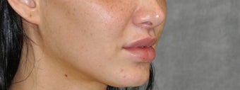 25-34 year old woman treated with Lip Lift after 3175794