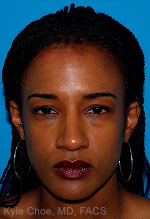 African American Rhinoplasty after 1445202