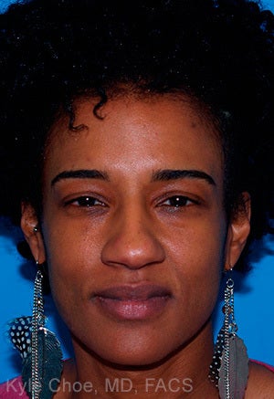 African American Rhinoplasty before 1445202