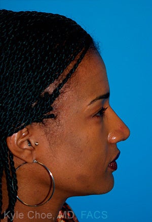 African American Rhinoplasty 1445202