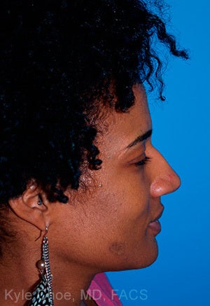 African American Rhinoplasty 1445202