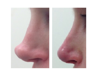 Non-surgical nose job using Restylane before 1360144