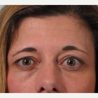 35-44 year old woman treated with Brow Lift before 3261200