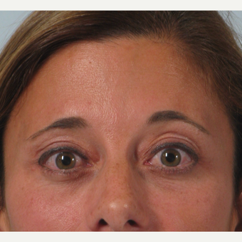 35-44 year old woman treated with Brow Lift after 3261200