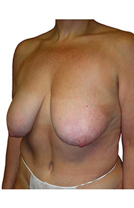 Mastopexy (breast lift) 320241