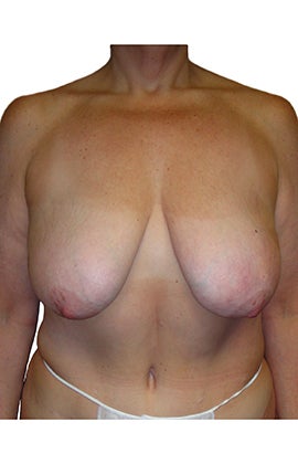 Mastopexy (breast lift) before 320241