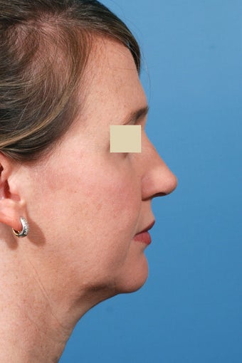 Rhinoplasty after 94697
