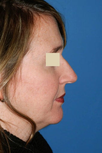 Rhinoplasty before 94697