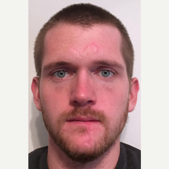 25-34 year old man treated with Facial Reconstructive Surgery after 3741620
