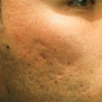 25-34 year old man treated with Acne Scars Treatment before 2750736