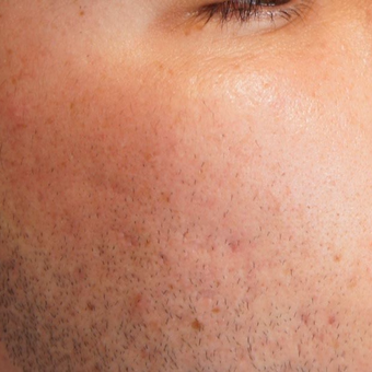 25-34 year old man treated with Acne Scars Treatment after 2750736