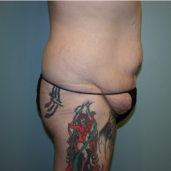 Brazilian Butt Lift before 3667542