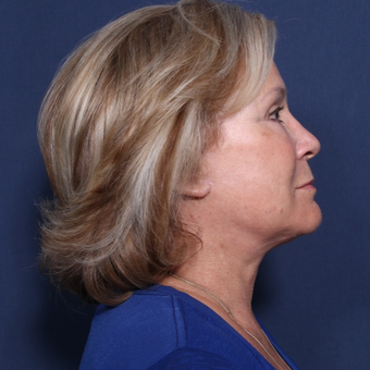 65-74 year old woman treated with Neck Lift (view 2 of 2) after 3175314