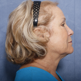 65-74 year old woman treated with Neck Lift (view 2 of 2) before 3175314