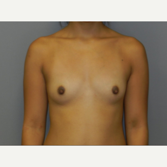 18-24 year old woman treated with Breast Fat Transfer before 3097391