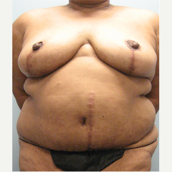 71 year old woman treated with Body Lift after 3680303
