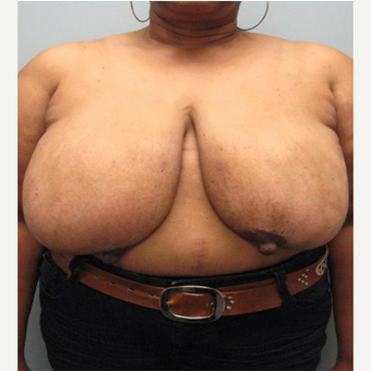 71 year old woman treated with Body Lift before 3680303