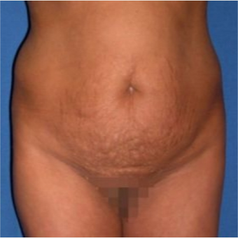 35-44 year old woman treated with Tummy Tuck before 3009727